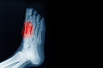 A Closer Look at Foot Pain From Sesamoiditis - Kevin J. Powers ...